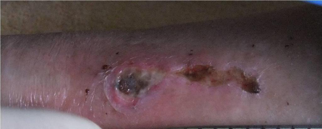 Slika 16: Primer rane na desni goleni pred