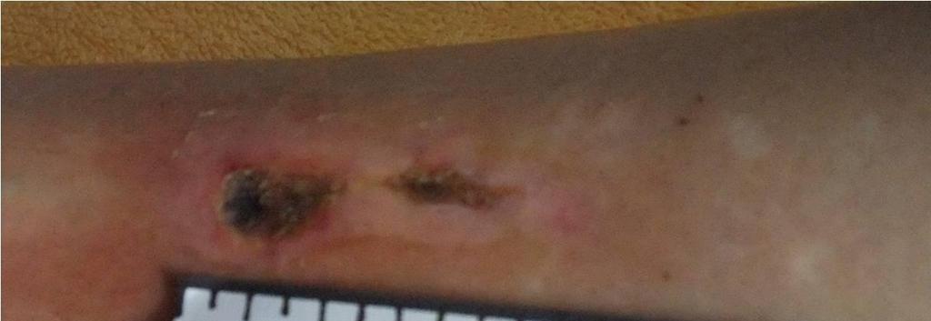 Slika 17: Primer rane na desni goleni po