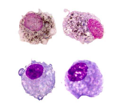 Nabiranje ogljika v makrofagih pri odraslih in otrocih, ki so