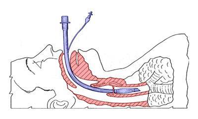 Slika 5: Prikaz vstavljene dihalne cevke Vir:http://doktori.