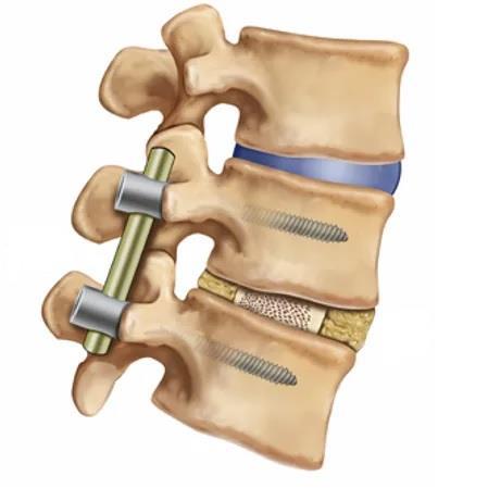 d) Spondilodeza in ostale inštrumentirane operacije So najzahtevnejše operacije s ciljem zatrditve gibalnega hrbteničnega segmenta ali več segmentov. Za dosego tega cilja so potrebni vsadki.