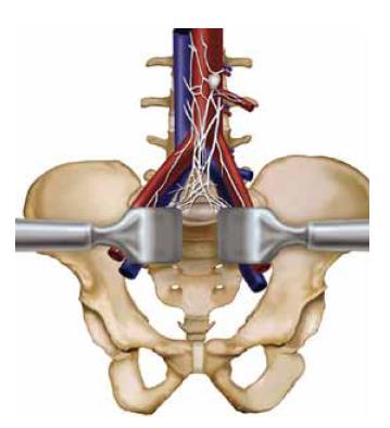 Tveganja za kirurški zaplet pri prednjem pristopu za ALIF se nanašajo na anatomske strukture, ki se nahajajo ventralno ob hrbtenici.