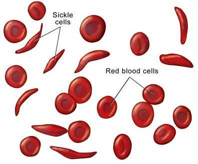 Hb in bolezni Cca 7% ljudi na svetu je prenašalcev za eno od nepravilnosti hemoglobina Znanih je ~ 1000 nenormalnih Hb Hemoglobinopatije nastanek nenormalnih globinskih verig (primer srpasta anemija