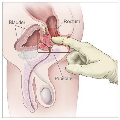(Slika 6): Rektalni pregled s tipanjem prostate Vir: http://cancer-prostate77.