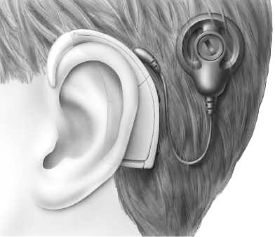 KVARKADABRA PRI ZDRAVNIKU Da bi oseba s hudo ali popolno izgubo sluha slišala, pa preteče kar nekaj časa. Najprej je treba namestiti notranji del polževega vsadka, kar je srednje zahtevna operacija.