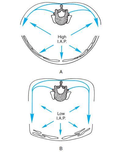 Slika 6. Princip delovanja intraabdominalnega pritiska (Kisner in Colby, 2007). Na Sliki 6 je prikazan princip delovanja intraabdominalnega pritiska. (A) Povečan intraabdominalni pritisk (High I.A.P.) pritiska navzven proti transversus abdominisu in internal obliques, tako poveča napetost na torakolumbalno ovojnico, kar omogoča stabilnost hrbtenice.