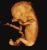 128 STROKOVNA SREČANJA Plod v 12. tednu nosečnosti. Plod v 22. tednu nosečnosti. Plod v 25. tednu nosečnosti. zato nam tridimenzionalna diagnostika nudi več informacij in nas približa resničnosti.