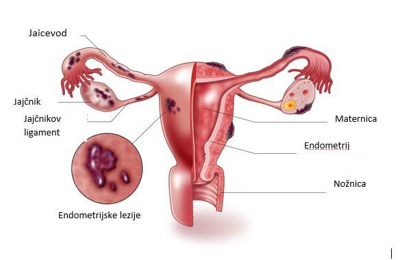 6.1. Endometrioza Endometrioza je pojav tkiva s histološkimi in funkcionalnimi značilnostmi endometrija (sluznice maternice) zunaj maternične votline (slika 11).