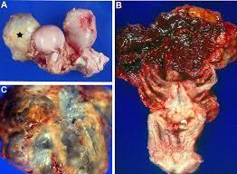 Slika 16: Endometrioza pri Rhesus opicah slika a prikazuje jajčnike, sliki b in c pojav cist Vir slike 16 (povzeto po): https://www.dpz.