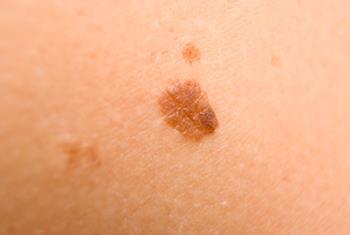 Dermatologi priporočajo, da si kožo pregledujemo redno, enkrat mesečno.