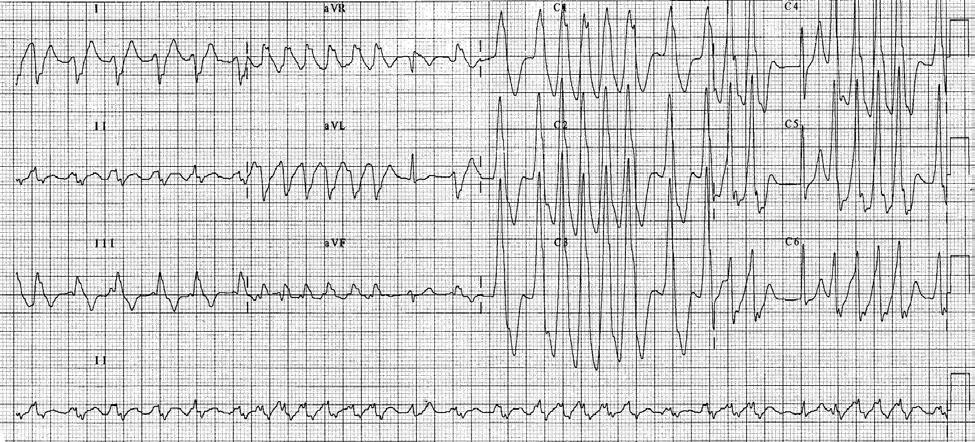 Vprašanje - 18 Pri 25 letnem rekreatvnem športniku smo v urgentni ambulant posneli naslednji EKG. EKG kaže na: 1.