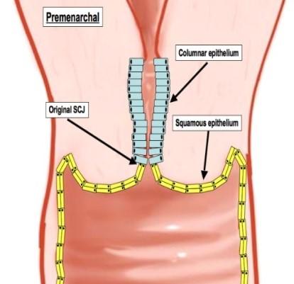 Slika 9: Transformacijska cona pred prvo menstruacijo (Histology Blog, 20