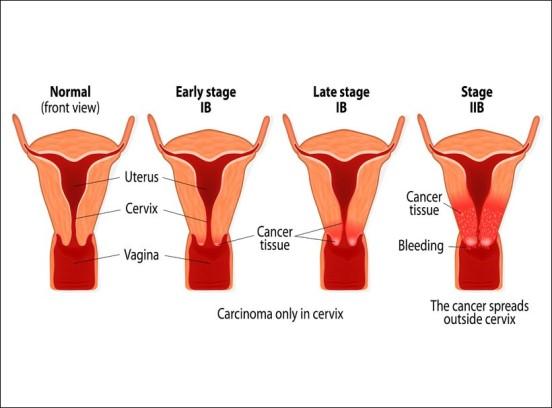 RMV se na začetku invazivne faze bolezni izrazi kot zadebelitev oz. zatrdlina epitelija, kot široka eflorescenca/vzbrst ali kot ulkus/ranica na materničnem vratu.