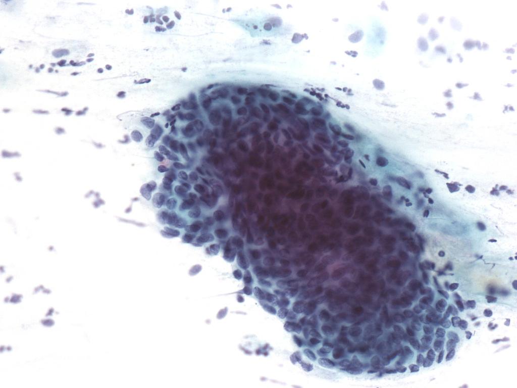 Slika 1. Atipične ploščate celice, neopredeljene (APC-N), Papanicolaou, x400. Slika 2.