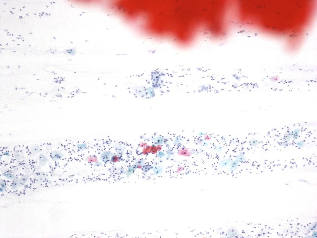 Atipične ploščate celice, neopredeljene (APC-N), Papanicolaou, x400. Slika 5.