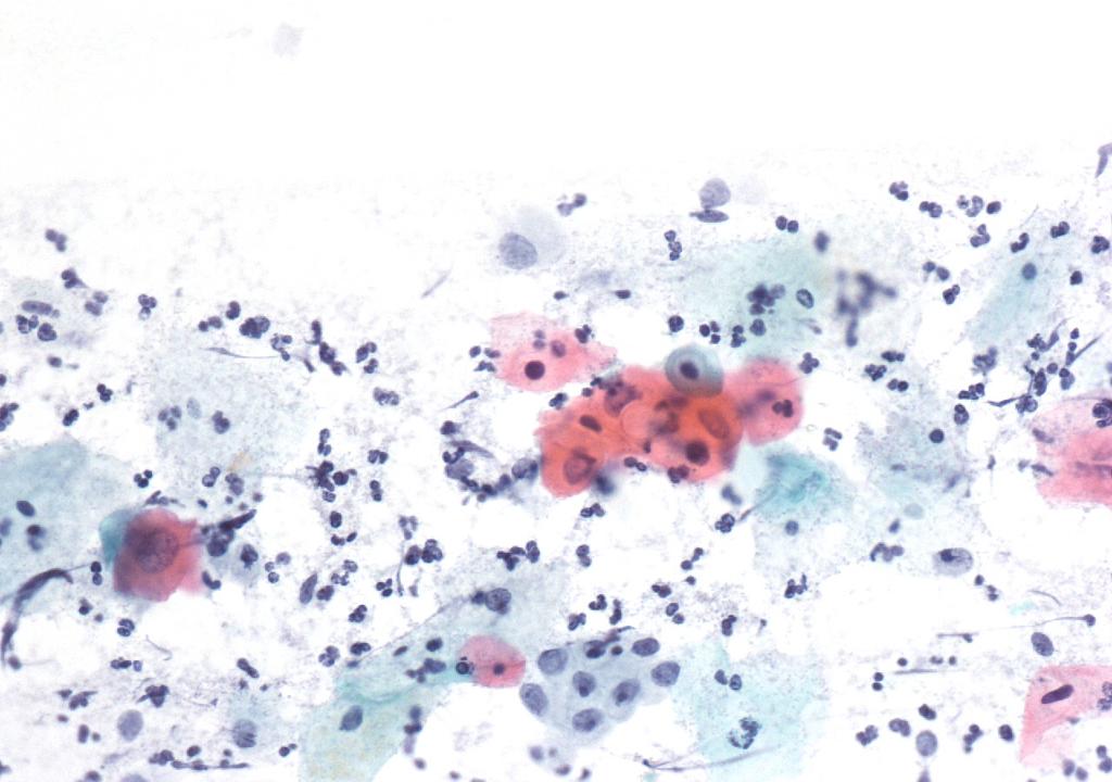 Atipične ploščate celice, neopredeljene (APC-N), Papanicolaou, x400.