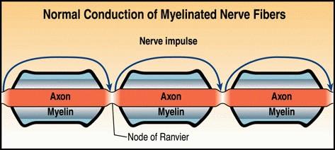 (propadanje živčnih celic) bolezen, pri kateri so poškodovani delci mielina,, ki obdaja živčna vlakna v možganih in hrbtenjači.