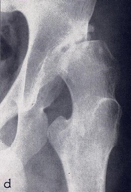 SEZNAM TELESNIH OKVAR VII: spodnji udi Funkcionalne motnje nepregibnost kolčnega sklepa v ugodnem ali neugodnem položaju; omejena