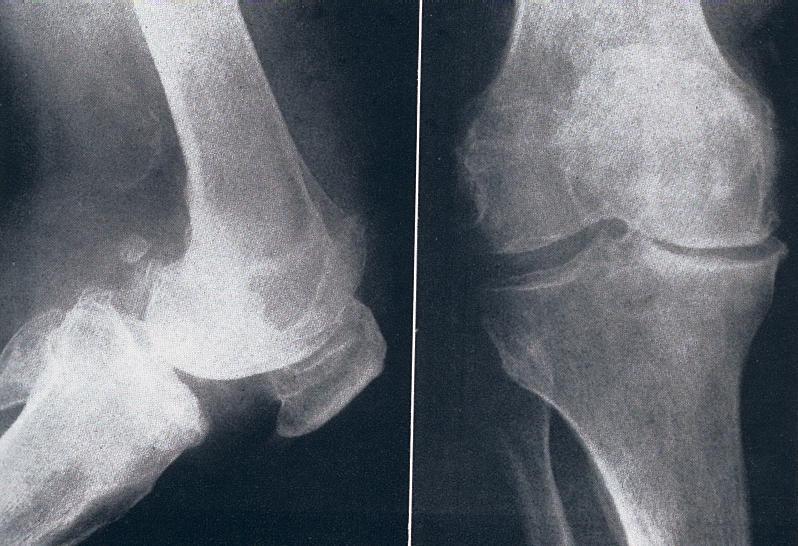 SEZNAM TELESNIH OKVAR VII: spodnji udi Funkcionalne motnje nepregibnost kolenskega sklepa v ugodnem