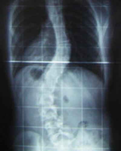 SEZNAM TELESNIH OKVAR VIII: hrbtenica torakalna kifoza (več