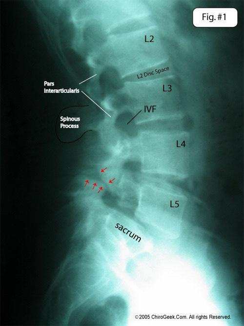 SEZNAM TELESNIH OKVAR VIII: hrbtenica spondilolisteza (premik