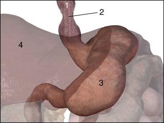 SEZNAM TELESNIH OKVAR IX: prebavni organi zožitev požiralnika, stanja po operaciji požiralnika, gastrektomije, stanja po večjih črevesnih