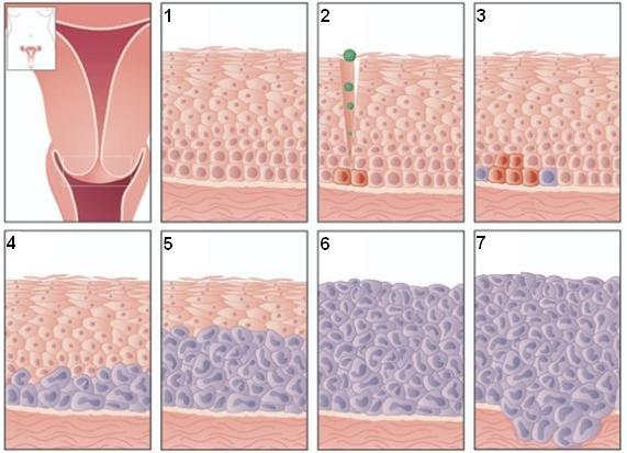 1.2.1 Histološki proces razvoja raka materničnega vratu Histološki proces razvoja RMV je prikazan na sliki 3. 1. Zdrav epitelij materničnega vratu. 2.