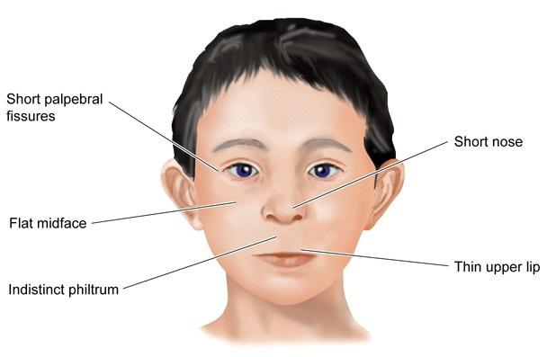 Fetalni alkoholni sindrom (FAS) - zastoj rasti (pred in po rojstvu) - značilen spremenjen videz obraza - poškodbe osrednjega živčevja - duševna manj razvitost (manjši, delno razviti možgani); -